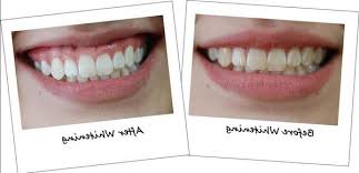 Tuto Blanchir Dents Gimp Avis D Expert