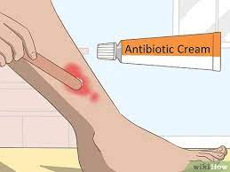 How To Prevent A Burn From Scarring: 13 Steps (With Pictures)