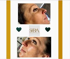 🪄 Dermaplaning facial for this beauty yesterday 😍 🪄Treatment time:  45minutes 🪄Pain: None 🪄Results: Smooth, glowing, hydrated skin 🤩  #dermaplaning #glowup #beauty #hydratedskin #aesthetics #ryde #pamper  #results #lovemyjob #feelgood