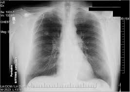 When detected in its earliest stages, lung cancer can often be successfully treated and sometimes even cured. Coccidioidomycosis Cancer Therapy Advisor