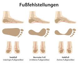 Wenn säuglinge bevorzugt in der bauchlage zum schlafen gelegt werden und sich die füßchen dabei nach innen drehen, kann es geschehen, dass der sichelfuß entsteht. Fussfehlstellung Spreizfuss Plattfuss Ubersicht Therapie