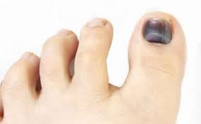 Para evitar crestas y líneas blancas en las uñas, es importante comer una saludable dieta bien balanceada. Unas Negras Que Son Y Como Tratarlas Nails Coruna