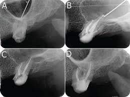 The target of this program is to reduce inflammation, sooth the mucous membrane and create an optimal sinus environment. An Iatrogenic Foreign Body In The Maxillary Sinus Report Of An Unusual Case