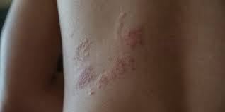 Sie werden vom selben erreger verursacht. Gurtelrose Bei Kindern Ursachen Symptome Und Behandlung