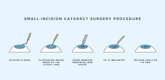 Image result for Cataract Extraction