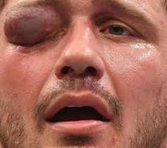 Chris weidman was not so fortunate. Chris Weidman Divulga Foto De Mao Operada Apos Lesao Nos Eua