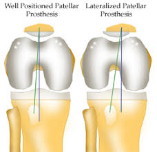 Image result for Patella Tracking Assessment