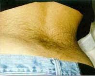 Wondering what the best facial hair remover is? Laser Hair Removal Before After Photos