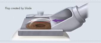 Hoopes Vision On Twitter Lasik Lasik Surgery Best Contact Lenses
