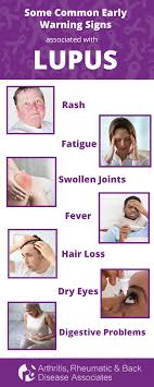 However, women get the disease more often than. Tips For Living With Lupus And How Arbda Can Help Arthritis Rheumatic Back Disease Associates Arthritissj Com