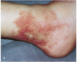 Red itchy rashes or can say small grains on legs and hands from past 3 month's. Skin Signs Of Vascular Disorders Cardiology