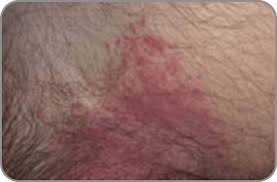 Caused by a fungal infection, jock itch isn't usually serious, but it's certainly an uncomfortable condition. What Is Jock Itch What Causes Jock Itch Lotrimin