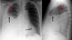 ما لانعرفه عن مياه الرئة جريدة الفراعنة