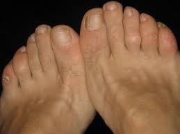 Baking soda has an alkaline property that helps to balance the ph level of the feet which creates an unfavorable environment it is an excellent exfoliator that softens the skin and removes the unsightly calluses and peeled skin caused by athlete's foot. 8 Old Time Remedies For Corns And Calluses