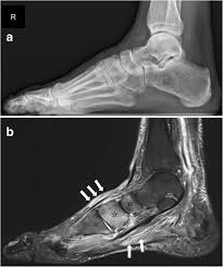 Charcot foot is a condition causing weakening of the bones in the foot that can occur in people who charcot foot is a serious condition that can lead to severe deformity, disability and even amputation. The Charcot Foot A Pictorial Review Insights Into Imaging Full Text
