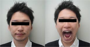 Treatment and evaluation of dysphagia rehabilitation especially