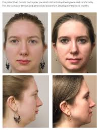 agga patient 6 months by leonard kundel アデノイド