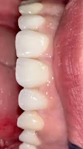 Veneers & Crowns & implant too,, Do you want to see how i make it?, Come to  DTG Symposium,September,Alsip,GC America,for registration;,  www.dtgevents.com I WILL BE THERE!!!