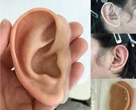 Prosthetic Ear - Ear Prosthesis - Microtia | Wisconsin — Life ...