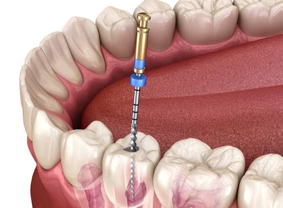 Root Canal Treatment Wakad