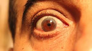 Una Mujer Es Incapaz De Cerrar Completamente Los Ojos Despues De Una Cirugia Fallida
