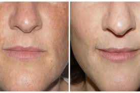 *rejuvenation (aging) reversing the aging process *rejuvenation (river) when the base level that a river is flowing down to is lowered * rejuvenation (album) 1974 funk. Ipl Laser Facial Rejuvenation Treatment St Mary Medical Centre