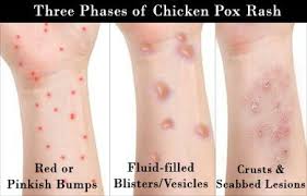 Kesan parut ini menjejaskan keyakinan dalam penampilan diri. Cara Hilangkan Parut Chicken Pox Dengan Cepat Pengedar Shaklee Sah Malaysia