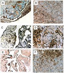 The mesothelium is the lining or membrane that covers and protects various internal organs of the body. Plos One Genome Wide Profile Of Pleural Mesothelioma Versus Parietal And Visceral Pleura The Emerging Gene Portrait Of The Mesothelioma Phenotype