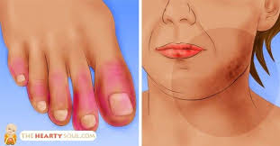 13 Early Warning Signs Of Lupus You Need To Know And What To Do The Moment You See Them Lupus Signs Lupus Symptoms Rheumatoid Arthritis Diet