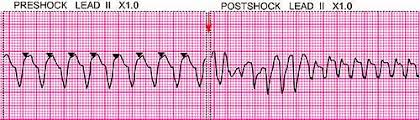 Image result for Synchronized Cardioversion