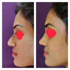 The cost of a rhinoplasty surgery in india varies between 50k to 1 lakh. Nose Surgery Cost Bangalore Leading Nose Reshaping Rhinoplasty Surgeon In India