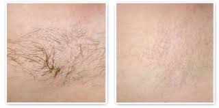 Ipl and laser hair removal simplified for practitioners and clients alike. Laser Hair Removal Ipl Treatment Clinic In Mississauga