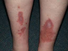 Diabetic dermopathy is a skin condition that is usually found on the lower legs of people with diabetes. Skin Problems Associated With Diabetes Mellitus Dermnet Nz