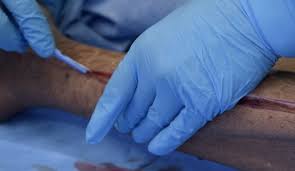 If edema forms in an injured extremity the eschar restricts the outward expansion of tissue. Escharotomy The Procedures Course Alfred Shock Trauma Resuscitation S T A R Program C