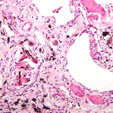The total cost of mesothelioma and asbestos lawsuits has been estimated at $325 billion in today&#x27;s dollars. Asbestos Lawsuit Settlements Mesothelioma Help