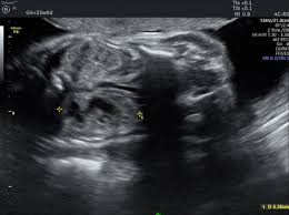 Fetal Hydronephrosis Radiology Reference Article Radiopaedia Org