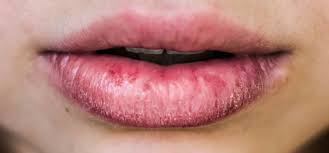 Eczema is a symptom, and getting rid of it depends on the cause. How To Treat Eczema On Your Lips Glamour Uk