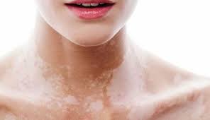 People suffering from this skin condition can develop white discolored skin patches anywhere on their bodies, including their faces. Want To Get Rid Of White Spots On Face Try These Effective Remedies Lifeberrys Com