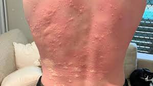 Image result for Fire Ant Sting