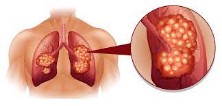 As the cancer develops, these symptoms may become more severe or intense. What Happens To Your Body When You Have Lung Cancer Lung Cancer Pintas Mullins Law Firm