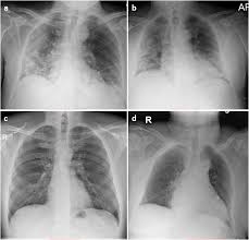 • the straight back syndrome or pectus. Machine Learning Applied On Chest X Ray Can Aid In The Diagnosis Of Covid 19 A First Experience From Lombardy Italy European Radiology Experimental Full Text