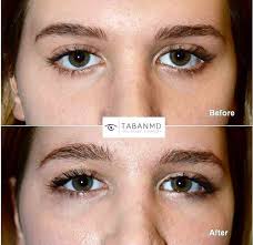 Pin By Mehryar Ray Taban Md On Before And After Photos Eye Surgery Almond Eyes Almond Shaped Eyes