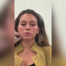 Nonsurgical treatment for jawline and chin