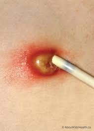 G Gj Tubes Preventing And Managing Infection