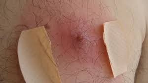 Das mit dem eingewachsenen härchen nach der rasur wäre auch meine vermutung. Pickel Genitalbereich Frau Sticht Sich Pickel Auf Saftiger Inhalt Blackhead