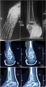 The ankle fracture was diagnosed from routine radiographs. Right Ankle Ap Lateral X Rays And Ct Scan Showed Fracture Medial Malleolus Download Scientific Diagram