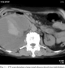 Image result for Perinephric Abscess
