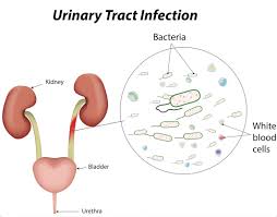 Do You Suffer From Urinary Tract Infections Austrials Website