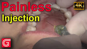 Why Are The Back Bottom Teeth The Hardest To Numb For Dental Procedures? -  Quora