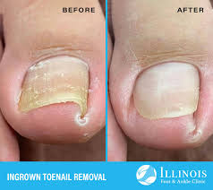 Image result for Toenail Removal